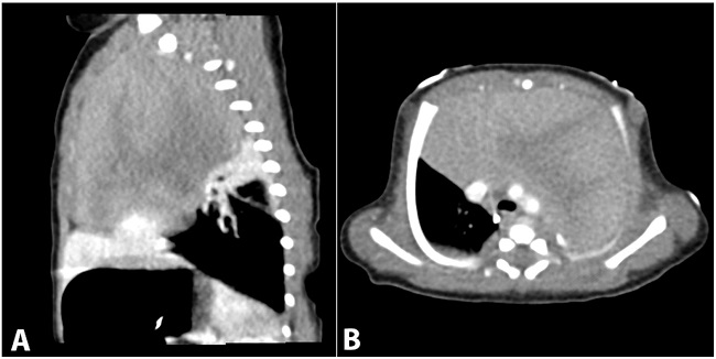 A &ndash; Sagittal contrast-enhanced thoracic computed tomography (CT) demonstrates a large, heterogeneously enhancing, anterior mediastinal mass. No calcification or necrosis is noted. The mass causes passive atelectasis of the adjacent right middle and upper lung lobes; B &ndash; Axial contrast-enhanced thoracic CT demonstrates a large anterior mediastinal mass with heterogeneous enhancement. The lesion exerts mass effect on the great vessels, displacing them posteriorly. Extrinsic compression on the tracheal is also noted, but the tracheal remains patent. No area of necrosis, calcification, or lymphadenopathy noted.