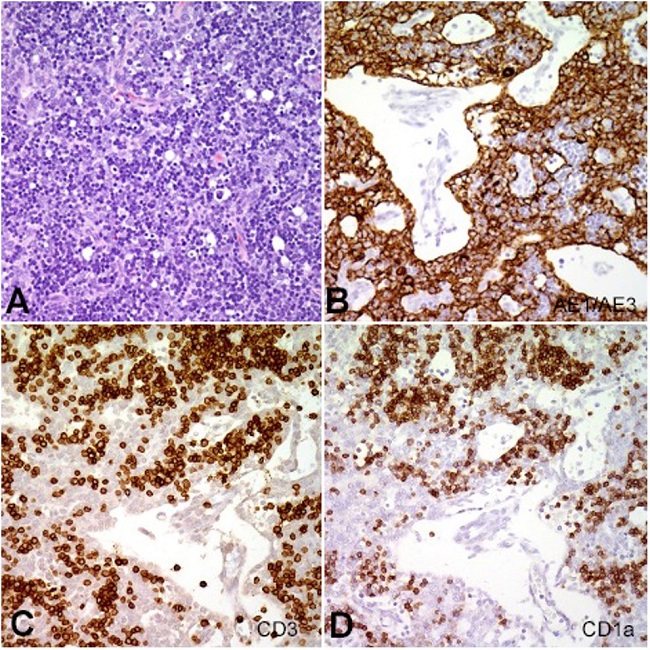 A &ndash; Hematoxylin eosin-stained section reveals mixed population of pleomorphic thymocytes in a background of bland appearing lymphocytes. Immunohistochemical stain reveals large proliferation of (B) CK AE1/AE3 positive thymocytes, and (C and D) CD3 and CD1a positive thymic lymphocytes.