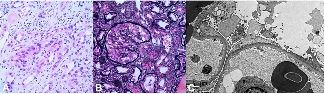 A &ndash; Light microscopy showing enlarged and hyperchromatic nuclei in some tubules (H and E &times;200); B &ndash; The glomeruli exhibiting podocyte hyperplasia (Jones methenamine silver satin, 200X); C &ndash; Electron microscopy showing diffuse foot process effacement with microvillous transformation.