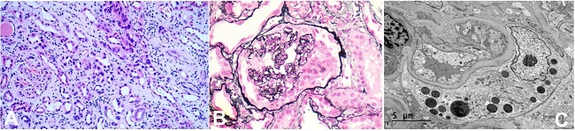 A &ndash; Light microscopy showing enlarged and hyperchromatic nuclei in some proximal tubules (H&E,100X); B &ndash; Jones methenamine silver satin showing collapse of capillary lumen and hyperplasia of podocytes (200x); C &ndash; Electron microscopy showing effacement of foot processes in the cytoplasm of podocytes and resorption granules.