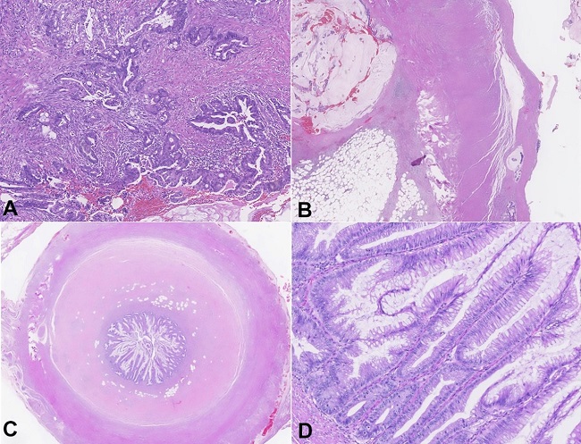 Photomicrographs of the ileocecal appendix. Area of invasive adenocarcinoma, with desmoplastic stroma and focal presence of extracellular mucus (inferior right corner) - H&E stain 10x (A). Appendicular wall, with neoplastic glandular structures in the subserosa (superior left corner) with a lake of mucus accompanied by rare neoplastic cell clusters (inferior left corner) - H&E stain lower magnification (B). Cross-section of the appendicular surgical top - H&E stain (C). Detail of the mucosa of the appendicular surgical top, where low-grade dysplasia lesions are observed - H&E stain 20x (D).