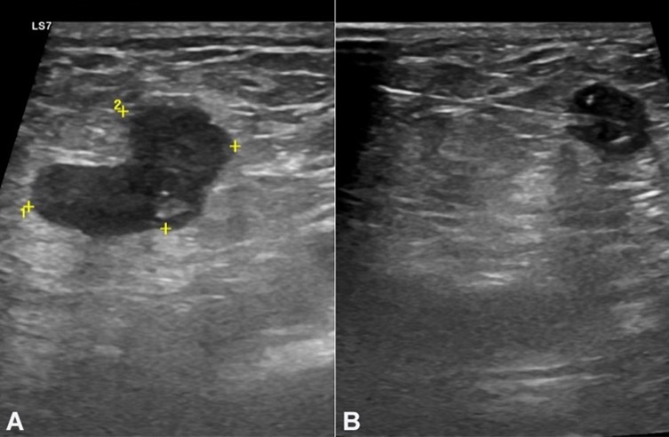 Inguinal ultrasound. Suspicious right inguinal adenomegaly measuring 20 x 11 mm (A) and the adenomegaly during the tru-cut biopsy (B).