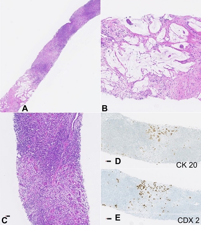 Photomicrographs of the lymph node biopsy. Fragment of a lymph node partially involved by adenocarcinoma metastasis, with growth areas in the form of small glands accompanied by stromal desmoplasia and others represented by extracellular mucus lakes accompanied by rare neoplastic glands - H&E stain lower magnification (A). Small neoplastic glands within a pool of extracellular mucus - H&E stain 10x (B). Area of lymph node tissue with multifocal metastatic involvement, due to adenocarcinoma, represented by multiple small neoplastic glands accompanied by mild desmoplastic stromal reaction - H&E stain 20x (C). Isolated neoplastic cells and several small neoplastic glands were highlighted by immunohistochemical staining for cytokeratin 20 (D) and CDX 2 (E) – 20x magnification.