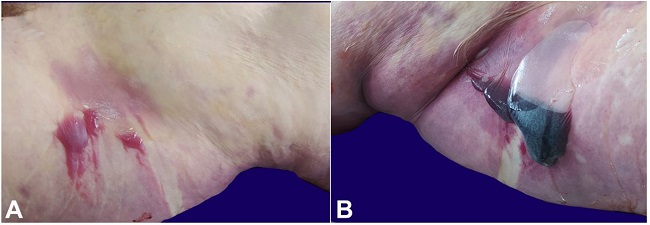Skin bullae; A &ndash; bullae in the first patient; B &ndash; bulla with pooled blood in the second patient.