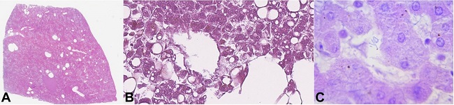 Histopathology of the liver from the first case. A &ndash; multiple optically empty areas, with varying size (H&E, 2x); B &ndash; rod-shaped bacteria in adjacent liver parenchyma without inflammatory reaction (H&E, 400x); C &ndash; rod-shaped bacteria in the liver parenchyma (H&E,1000x).