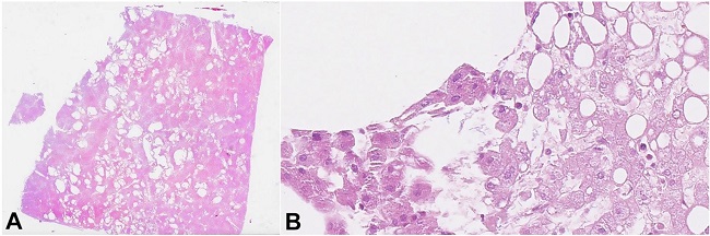 Histopathology of the liver from the second case. A &ndash; multiple large optically empty areas (H&E, 2x); B &ndash; rod-shaped bacteria in adjacent liver parenchyma without inflammatory reaction (H&E, 400x).
