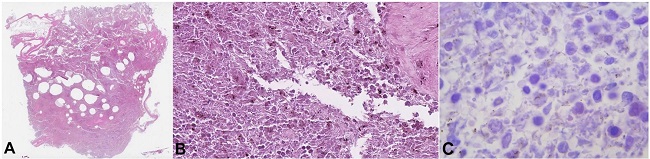 Histopathology of the spleen from the first case. A &ndash; multiple large optically empty areas (H&E, 2x); B &ndash; rod-shaped bacteria in adjacent parenchyma and bacterial colonies without inflammatory reaction (H&E 400x); C &ndash; rod-shaped bacteria in spleen parenchyma (H&E,1000x).