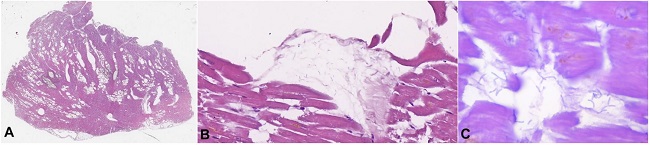 Histopathology of the myocardium from the second case. A &ndash; multiple optically empty areas, with varying size (H&E, 2x); B &ndash; rod-shaped bacteria in adjacent parenchyma without inflammatory reaction (H&E 400x); C &ndash; rod-shaped bacteria in the myocardium, H&E 1000x).
