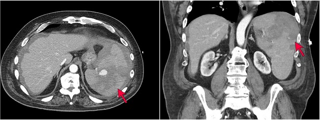 CT imaging demonstrating splenomegaly with hemorrhage, splenic laceration, and perisplenic hematoma (red arrows). Lymphadenopathy was also noted on imaging (not shown).