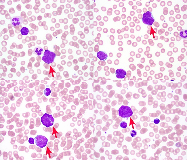 Peripheral blood smear (Wright Giemsa, 100X) demonstrating pleomorphic atypical lymphocytes (red arrows).