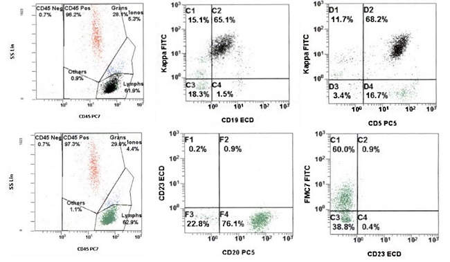 Flow cytometric analysis showing a clonal population of kappa-restricted CD5+ B-cells that express FMC7 and bright CD20 and lack CD23 (Top row: black dots backgated on CD19+ events).
