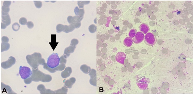 A – Peripheral blood smear showing blasts (arrow). (Leishman's stain, 1000x); B – Bone marrow aspirate smear showing blasts of myeloid lineage (Leishman's stain,1000x)