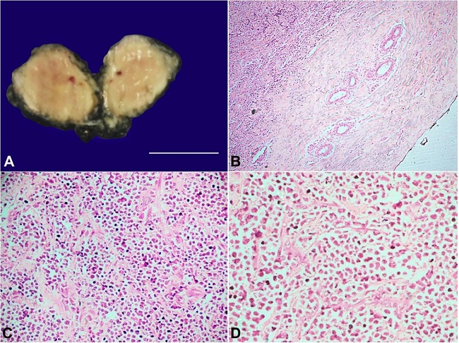 A – A gross view of the excised breast lump. Note the external surface appears smooth with the cut surface showing a greenish tinge (scale bar = 4 cm); B, C and D show sections from the breast mass, which reveal tumor cells composed of monomorphic population of cells, predominantly composed of blasts along with few scattered mature and immature granulocytes. Normal breast parenchyma is seen at the periphery in B, indicating that the tumor was circumscribed (H&E, B-100x; C - 200x; D - 400X).