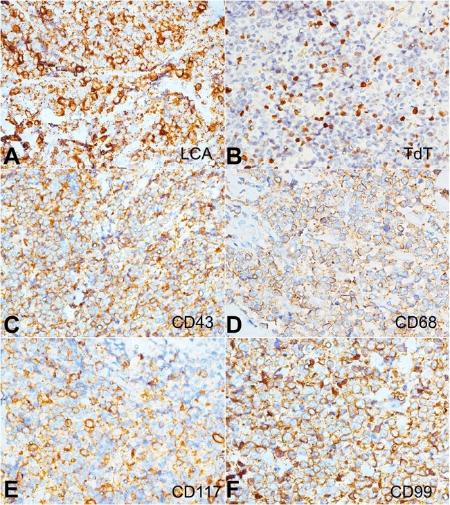 - Immunohistochemical profile of the breast lump - The tumor cells are strongly reactive for A – LCA; B – TdT highlights the myeloblasts; C – The tumor cells also react diffusely to CD43; D – CD68 (diffuse reactivity); E – CD117 (intermediate to weak reactivity); and F – CD99 (diffuse reactivity) (A to F, 400X).