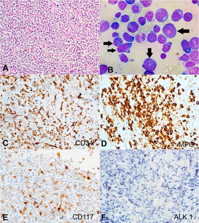 A – Photomicrograph of the lymph node showing the replacement of lymph node parenchyma with sheets of blasts (H&E, 400x); B – Bone marrow aspirate showing numerous blasts (arrows) along with other cells of myeloid lineage, indicating blast crises of CML (Leishman’s stain,1000x); C-F – Immunohistochemical profile of the lymph node reveals the blasts being diffusely positive for: C - CD34; D – MPO; E - focal reactivity to CD117; and F - non-reactivity to ALK1 - (C to F, 400x).