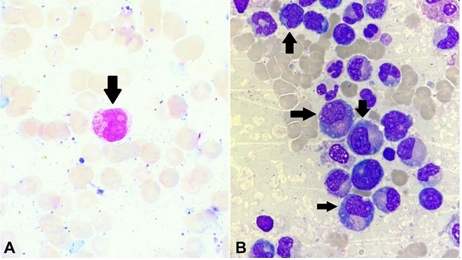 A – Peripheral blood smear showing an abnormal promyelocyte composed of an eccentric folded nucleus with nucleolus and abundant cytoplasm showing numerous granules along with the presence of Auer rods (arrow) (Leishman's stain, 1000x); B – Bone marrow aspirate shows promyelocytes (arrows) along with a few blasts and myeloid precursors (Leishman's stain, 1000x)