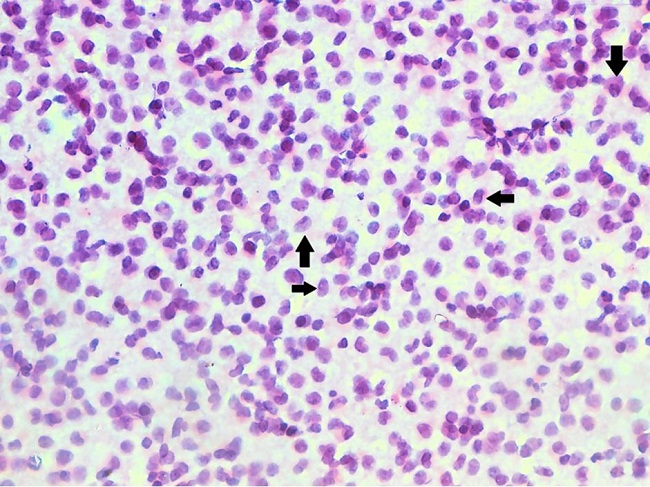 May Grunwald - Giemsa (MGG) stained smears from the FNAC of temporal swelling reveal a monomorphous population of cells composed of intermediate-sized cells with pinkish granular cytoplasm and prominent nucleoli (arrows), suggesting overall features to be of a hematolymphoid malignancy in a known case of APML (400x).