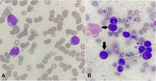 A – Peripheral blood smear showing the presence of myeloid blasts (Leishman stain,1000x); B – Bone marrow aspirate reveals presence blasts (arrows) with cells of myeloid lineage (Leishman stain, 1000x).