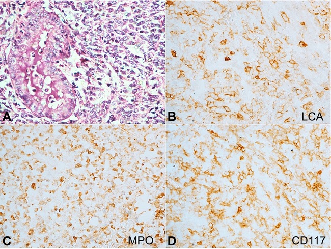 Photomicrographs of the cervical mass: A – shows scant endocervical glands along with stroma being infiltrated by atypical monomorphic cells in sheets (H&E, 400x); B-D – Immunohistochemical reactions reveal the atypical cells showing strong reactivity to: B - LCA, C – MPO, and D – CD117, indicating their myeloid lineage (400x).