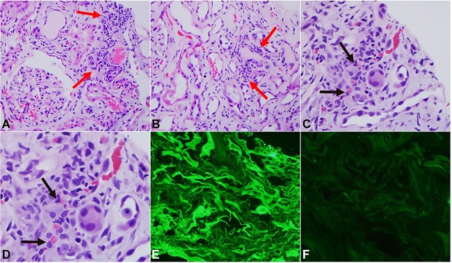 Microscopic and Immunofluorescence findings. (A) Interstitial inflammatory infiltrate (combination of eosinophils and mononuclear cells; black arrows) associated with tubulitis (red arrows), tubular damage, and interstitial edema. H&E x250. (B) Extensive tubular damage with simplification of tubules lined by flattened cells and interstitial inflammation with tubulitis. H&E x250. (C) and (D) Interstitial inflammation with tubulitis, edema, and tubular damage with eosinophils. H&E x250 in (C) and x500 in (D). (E) Immunofluorescence stain for lambda light chains, fluorescein isothiocyanate (x250) showing intense linear staining along tubular basement membranes and granular staining in the cytoplasm of some proximal tubular cells. (F) Immunofluorescence stain for kappa light chains (x250) with fluorescein isothiocyanate showing no staining in renal parenchyma.