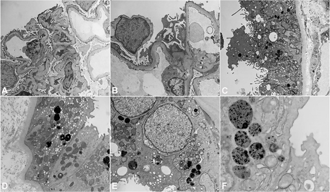 Electron Microscopy (EM) findings. (A) EM x7500 and (B) EM x12500 - Uranyl acetate and lad citrate stain showing no immune complexes, light chain deposits or fibrillary material. Mild, segmental effacement of the foot processes of visceral epithelial cells. (C) EM x7500 and (D) EM x7500 - Uranyl acetate and lead citrate stain showing apical blebbing, segmental loss of microvillous borders and lysosomes in cytoplasm of proximal tubular cells. (E) EM x12500 and (F) EM x18500 - Uranyl acetate and lead citrate stain showing details of lysosomes in proximal tubular cells. Note moth eaten appearance of lysosomes reflecting partial extrusion of their enzymatic contents.
