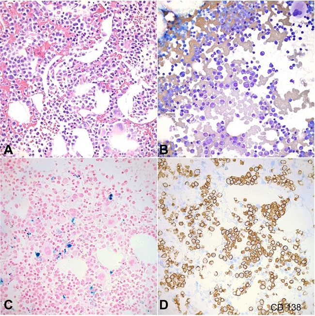 Bone marrow biopsy and aspirate findings. A &ndash; Bone marrow biopsy, and B &ndash; aspirate analysis showed a plasma cell neoplasm with lambda light chain restriction (H&E x400); C &ndash; Prussian blue staining revealed adequate iron storage (x400); D &ndash; CD138 stain was positive in increased numbers of plasma cells representing approximately 50% of the marrow cellularity (x400).