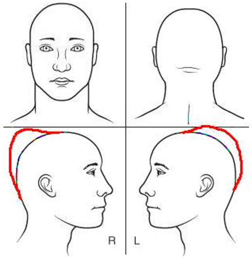 Schematic showing the location of the cranial mass in the patient&rsquo;s parieto-occipital region.
