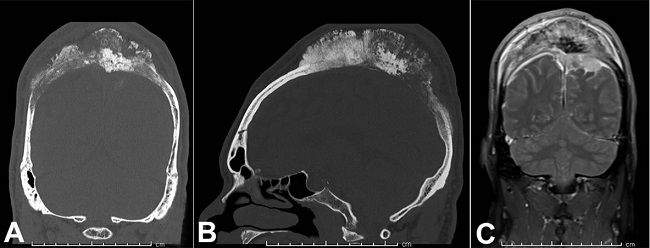 A and B (coronal and sagittal views respectively) &ndash; Bone computed tomography (CT). Large midline permeative calvarial lesion with areas of thickening/erosion of the inner table and extensive periosteal reaction; C &ndash; Coronal post-gadolinium fat-saturated T1 sequence. Large intraosseous mass with demonstration of intracranial extension, invasion into the superior sagittal sinus, and regional dural thickening and enhancement.