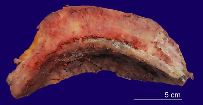 Gross examination of the resected bone. The image shows a fragment of calvarium measuring 22.5 cm in its longest axis, 7 cm in the coronal plane, and up to 1.5 cm in thickness. The bone is expanded by a mass.