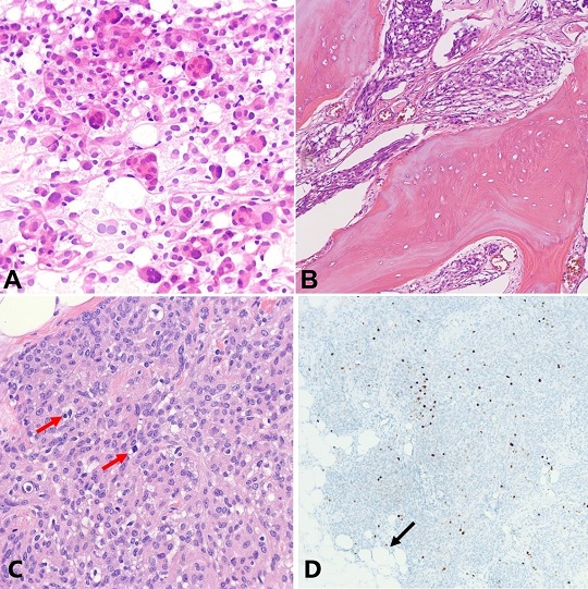 Photomicrographs of the tumor. A &ndash; Smear preparation showing cells with meningothelial differentiation forming whorls (H&E, 400x); B &ndash; predominantly intraosseous tumor with associated hyperostosis (H&E 200x); C &ndash; few scattered mitotic figures (red arrows) (H&E 400x); D &ndash; focally elevated Ki-67 proliferation rate (100x); and invasion into adipose tissue (arrow).