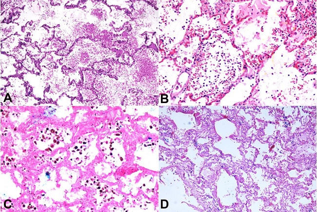 Photomicrograph of lungs: A &ndash; showing septal congestion with intra-alveolar hemorrhage (H&E 10X); B &ndash; showing septal congestion, intra-alveolar hemorrhage, and infiltration of neutrophils (H&E 20X); C &ndash; hemosiderin-laden macrophages in intra-alveolar spaces (Perl's Prussian blue 20X); D- hyaline membrane in alveolar walls (H&E 10X).