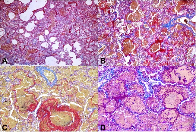 Photomicrographs of lungs: A, B &ndash; Hyaline membrane highlighted with Martius scarlet blue in bright red (M.S.B 4X,10X); C &ndash; Hyaline membrane and intra-alveolar fibrin deposition highlighted by M.S.B (20X); D &ndash; Hyaline membrane and intra-alveolar fibrin deposition highlighted by Masson's trichrome stain (20X).