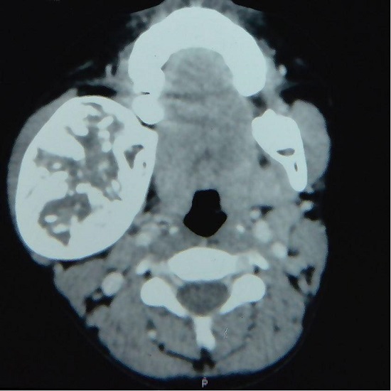 Facial computed tomography showing a lytic lesion in the right body of the mandible involving the cortex.