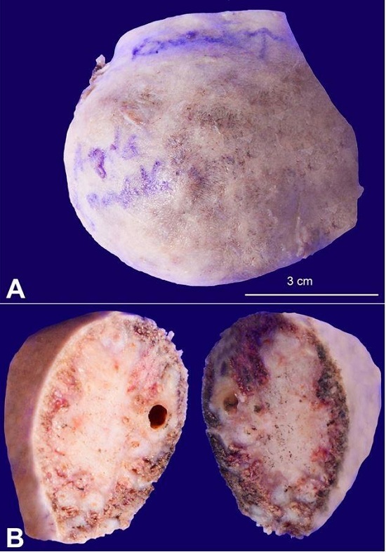 A – The gross image of the hemimandibulectomy specimen showing the expansile tumor with a smooth outer surface; B – Macroscopic view of the cut surface showing a poorly circumscribed light-grey lesion.