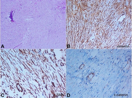 Photomicrographs of the tumor. A – Hypocellular collagenized stroma with thin bony trabeculae (H&E, 400X); B – Diffuse cytoplasmic positivity for vimentin in the tumor cells and the endothelial cells (400X); C – Cytoplasmic positivity for SMA in the tumor cells (400X); D – Absence of staining by ß-catenin in the tumor cells with positive internal control (endothelial cells) (400X).