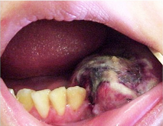 Intraoral examination shows a bulging lesion with central necrosis erupting the buccal and lingual cortical bone.