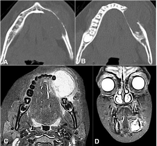 A and B - Axial computed tomography of the mandible revealing the rupture of the lingual and buccal cortical bone. C and D - Facial magnetic resonance imaging C axial plane and D coronal plane. Images weighted in T2 revealing the size and the projection of the buccal and lingual lesion.