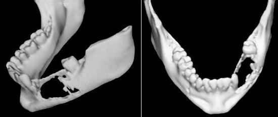 Three-dimensional reconstruction of the mandible illustrating the tumor extent with irregular bone resorption.
