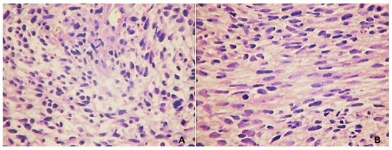 Photomicrographs of the tumor. A - Cellular arrangements in loose bundles, perivascular disposition, and areas of myxoid aspect. The cells are elongated, with poorly defined borders, and the nuclei are equally elongated and atypical (HE, 400&times;). B - Cellular arrangements in bundles with occasional &ldquo;fishbone&rdquo; arrangement, fibrosarcoma-like. Note the presence of mitoses (HE, 400&times;).