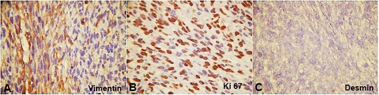 Photomicrographs of the tumor. A - Streptavidin-biotin-peroxidase. Mayer&rsquo;s hematoxylin and diaminobenzidine. Occasional vimentin positivity. B - Streptavidin-biotin-peroxidase. Mayer&rsquo;s hematoxylin and diaminobenzidine. Ki-67 proliferative index. C - Streptavidin-biotin-peroxidase. Mayer&rsquo;s hematoxylin and diaminobenzidine. Negativity to desmin.