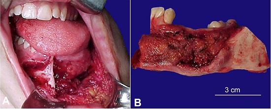 A - Intraoperative view of the segmental mandibulectomy. B - Resected surgical.