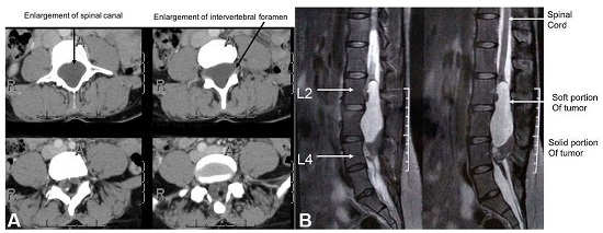 A &ndash; spine CT axial plane showing intraspinal lesion with enlargement of vertebral canal suggesting a slow growing lesion; B &ndash; Spine MRI, sagittal plane showing lumbosacral region showing a heterogenous intramedullary lesion from L2 to L4 levels.