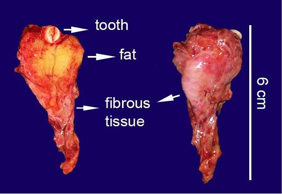 Gross view of the surgical specimen, ventral, and dorsal views are showing fat, fibrous tissues, and a tooth.