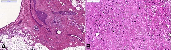 Photomicrographs of the surgical specimen. A &ndash; presence of mature, adult-type tissues - skin with cutaneous appendages, connective, and adipose tissues; B &ndash; neural component, predominantly composed of glial cells and neuropil.