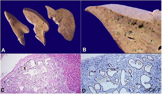 A and B - Cut surface of the liver show presence of multiple bile stained lesions measuring 3 to 15 mm in diameter in subcapsular location. B A closer view of the subcapsular bile stained lesions; C and D – Photomicrographs of the liver shows mis-shaped dilated bile ducts lined by cuboidal cells, embedded in a fibrotic stroma (H&E, 200X) and cuboidal cells lining the ducts show cytoplasmic staining for Cytokeratin 7.