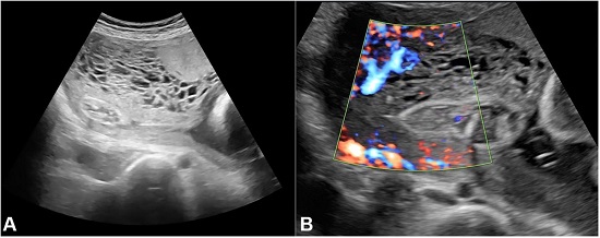Ultrasound showing placenta with the cystic area.