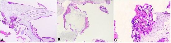 Photomicrographs of the placenta showing in A, B, and C – Hydropic avascular villi with cisterns and trophoblastic hyperplasia.
