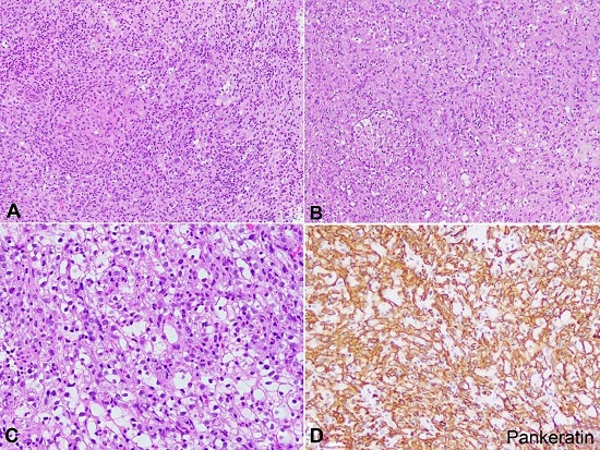 Photomicrographs of the lung nodule. A &ndash; Poorly differentiated chordoma. The tumor is composed of sheets of epithelioid cells with eosinophilic cytoplasm (H&E, 100X); B &ndash; Poorly-differentiated chordoma. Notice the well-formed granuloma and the cells with clear cytoplasm in the lower right corner (H&E, 100X); C &ndash; Poorly-differentiated chordoma. Focal areas show tumor cells with clear to vacuolated cytoplasm admixed with epithelioid cells (H&E 200X); D &ndash; Pankeratin immunohistochemical stain highlighting the lesional cells (Pankeratin immunohistochemical stain, 100X).