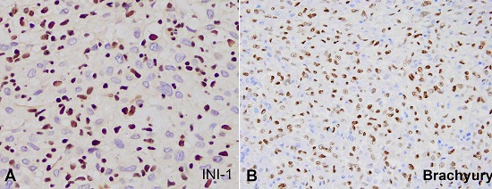 Photomicrographs of the lung nodule. A &ndash; INI-1 immunohistochemical stain in poorly differentiated chordoma. Notice the loss of expression in the tumor cells and the intact expression in the inflammatory cells (400X); B &ndash; Brachyury immunohistochemical stain in poorly differentiated chordoma (200X).