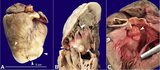Gross view of the heart. A - Anterior face of the heart showing several whitish nodules (arrowheads); B - Right ventricular outflow tract with some of the nodules represented on the cut surface (arrowheads); C - Left ventricular outflow tract evidencing subaortic obstruction by the largest rhabdomyoma of the interventricular septum (arrowhead).